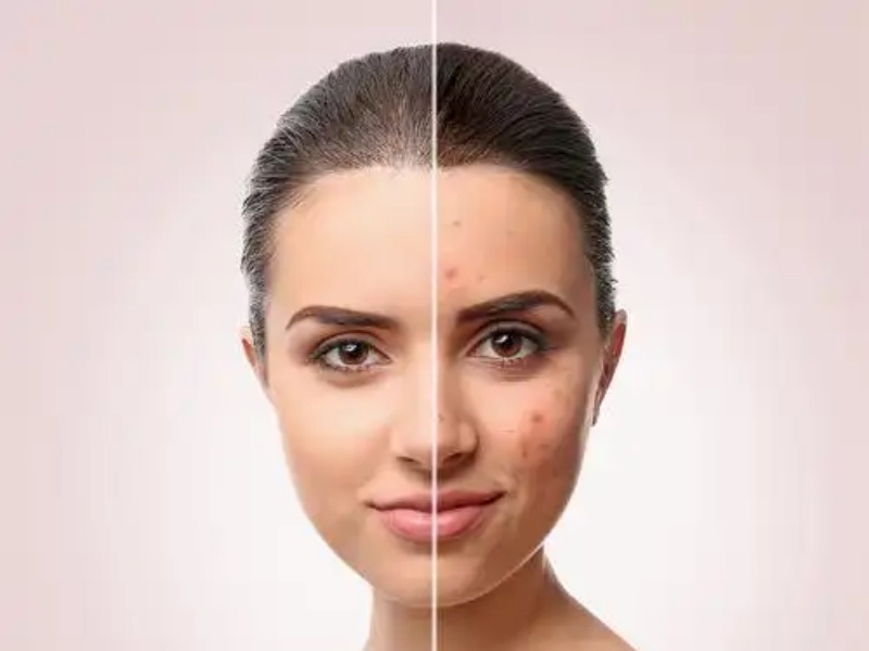 The Zinc Timeline: How Long to Take Zinc for Hormonal Acne Relief?